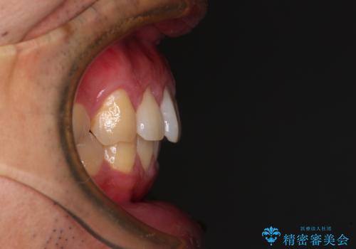 気になる前歯を短期間で改善 下顎の部分矯正と上顎のオールセラミッククラウンの治療後