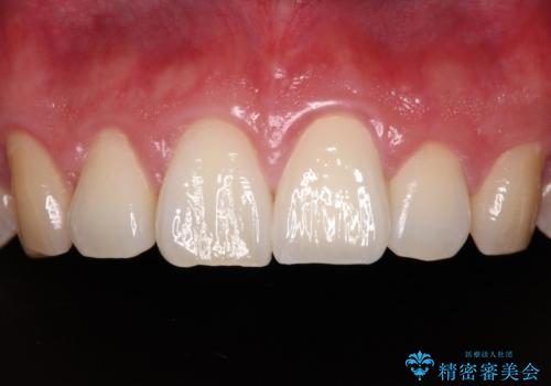 気になる前歯を短期間で改善　下顎の部分矯正と上顎のオールセラミッククラウンの症例 治療後