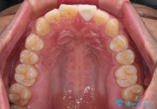 気になる前歯を短期間で改善　下顎の部分矯正と上顎のオールセラミッククラウンの治療後