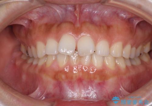 隙間の空いた前歯を閉じたい　インビザライン矯正の症例 治療前