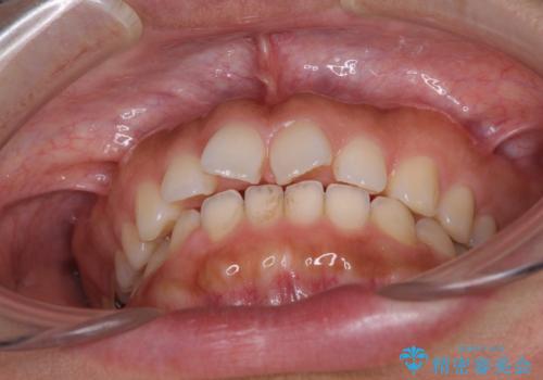 隙間の空いた前歯を閉じたい インビザライン矯正の治療前