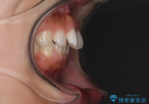 隙間の空いた前歯を閉じたい インビザライン矯正の治療前
