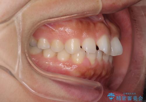 隙間の空いた前歯を閉じたい　インビザライン矯正の治療前