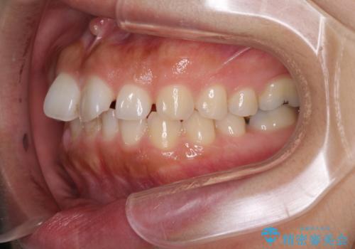 隙間の空いた前歯を閉じたい インビザライン矯正の治療前