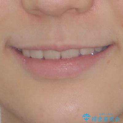 目立つ八重歯を治したい　インビザラインによる矯正治療の治療後（顔貌）