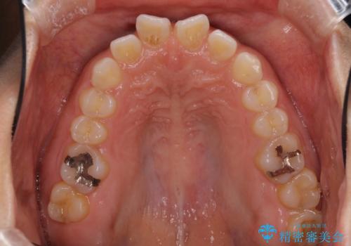 隙間の空いた前歯を閉じたい　インビザライン矯正の治療前