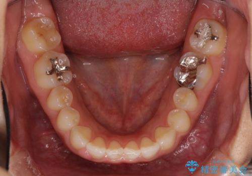 隙間の空いた前歯を閉じたい インビザライン矯正の治療前