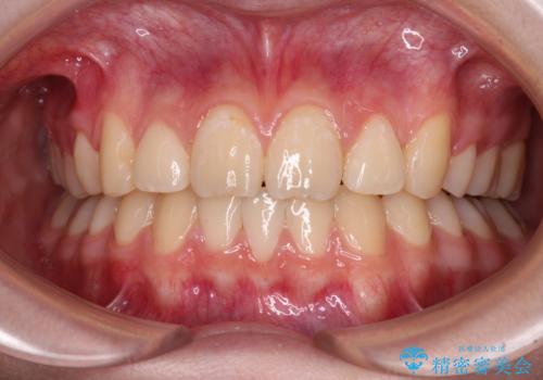 目立つ八重歯を治したい　インビザラインによる矯正治療の症例 治療後