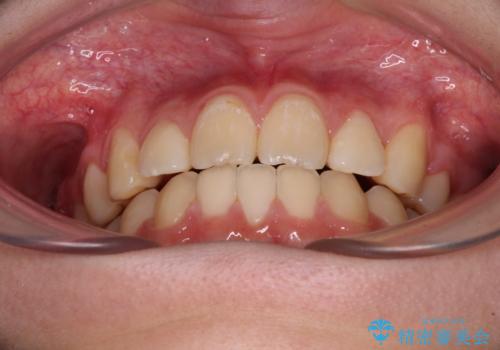 目立つ八重歯を治したい　インビザラインによる矯正治療の治療後