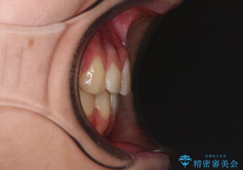 目立つ八重歯を治したい インビザラインによる矯正治療の治療後