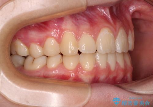 目立つ八重歯を治したい インビザラインによる矯正治療の治療後