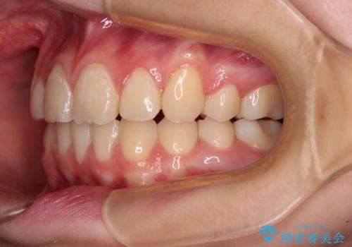 目立つ八重歯を治したい インビザラインによる矯正治療の治療後