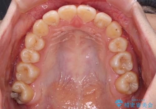 目立つ八重歯を治したい インビザラインによる矯正治療の治療後