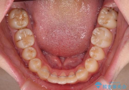 目立つ八重歯を治したい インビザラインによる矯正治療の治療後