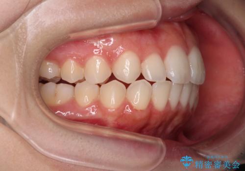 【モニター】前歯のクロスバイトをインビザラインで治療の治療中