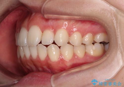 【モニター】前歯のクロスバイトをインビザラインで治療の治療中