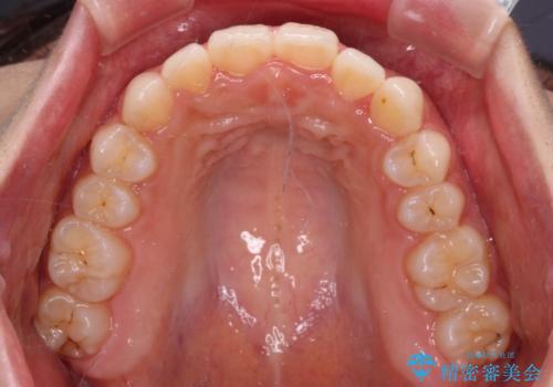 【モニター】前歯のクロスバイトをインビザラインで治療の治療中
