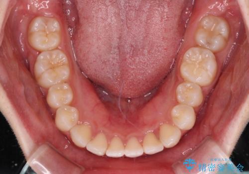 【モニター】前歯のクロスバイトをインビザラインで治療の治療中