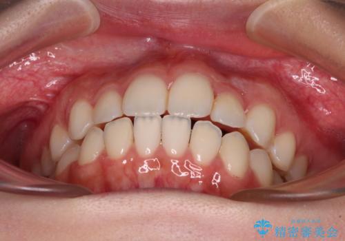 【モニター】前歯のクロスバイトをインビザラインで治療の治療中