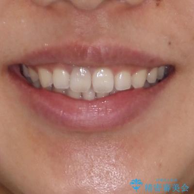 隙間の空いた前歯を閉じたい　インビザライン矯正の治療後（顔貌）