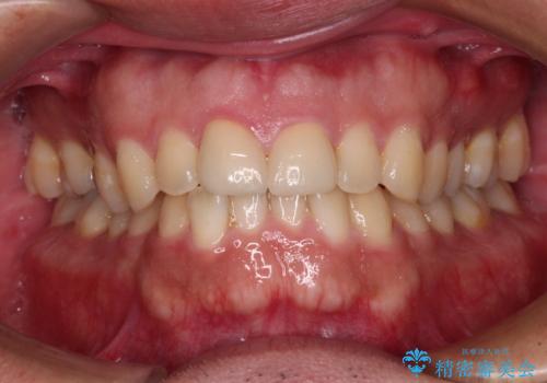 ロードバイク運転中に転倒 欠けてしまった前歯のオールセラミック治療の治療後