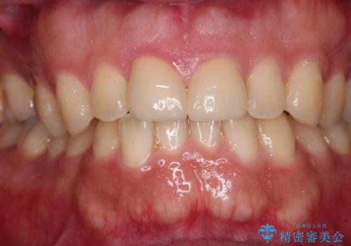 ロードバイク運転中に転倒 欠けてしまった前歯のオールセラミック治療の治療後