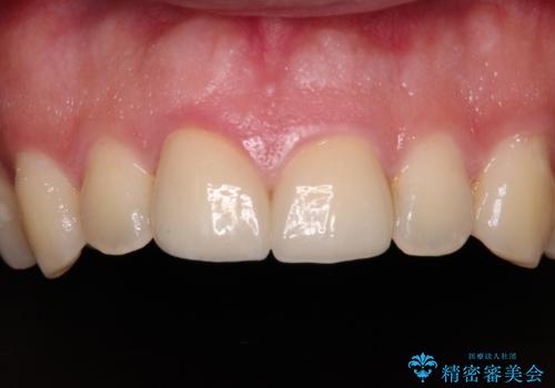 ロードバイク運転中に転倒 欠けてしまった前歯のオールセラミック治療の治療後