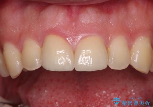 ロードバイク運転中に転倒 欠けてしまった前歯のオールセラミック治療の治療後