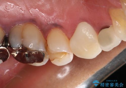 食事の度に痛む 根管治療とオールセラミッククラウンの治療後