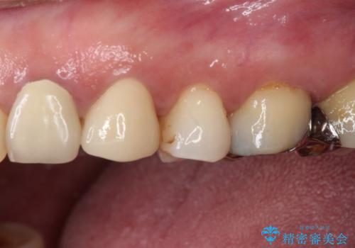 食事の度に痛む 根管治療とオールセラミッククラウンの治療後