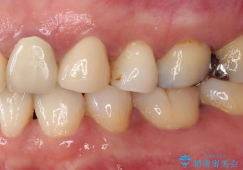 食事の度に痛む 根管治療とオールセラミッククラウンの治療後