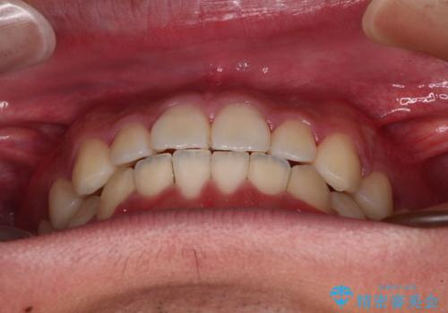 軽微叢生をインビザラインで 廉価版パッケージでの矯正治療の治療後