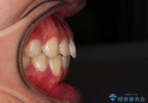 軽微叢生をインビザラインで 廉価版パッケージでの矯正治療の治療後