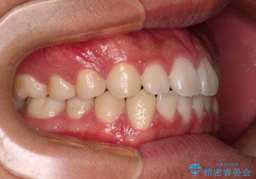 軽微叢生をインビザラインで 廉価版パッケージでの矯正治療の治療後