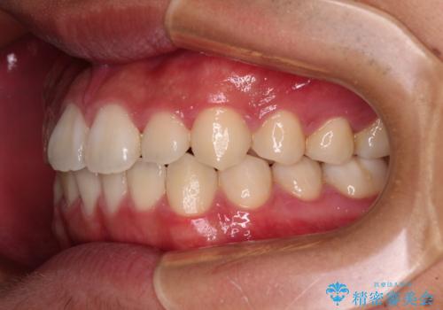 軽微叢生をインビザラインで 廉価版パッケージでの矯正治療の治療後