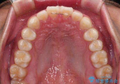 軽微叢生をインビザラインで 廉価版パッケージでの矯正治療の治療後