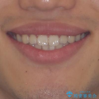 軽微叢生をインビザラインで 廉価版パッケージでの矯正治療の治療後(顔貌)