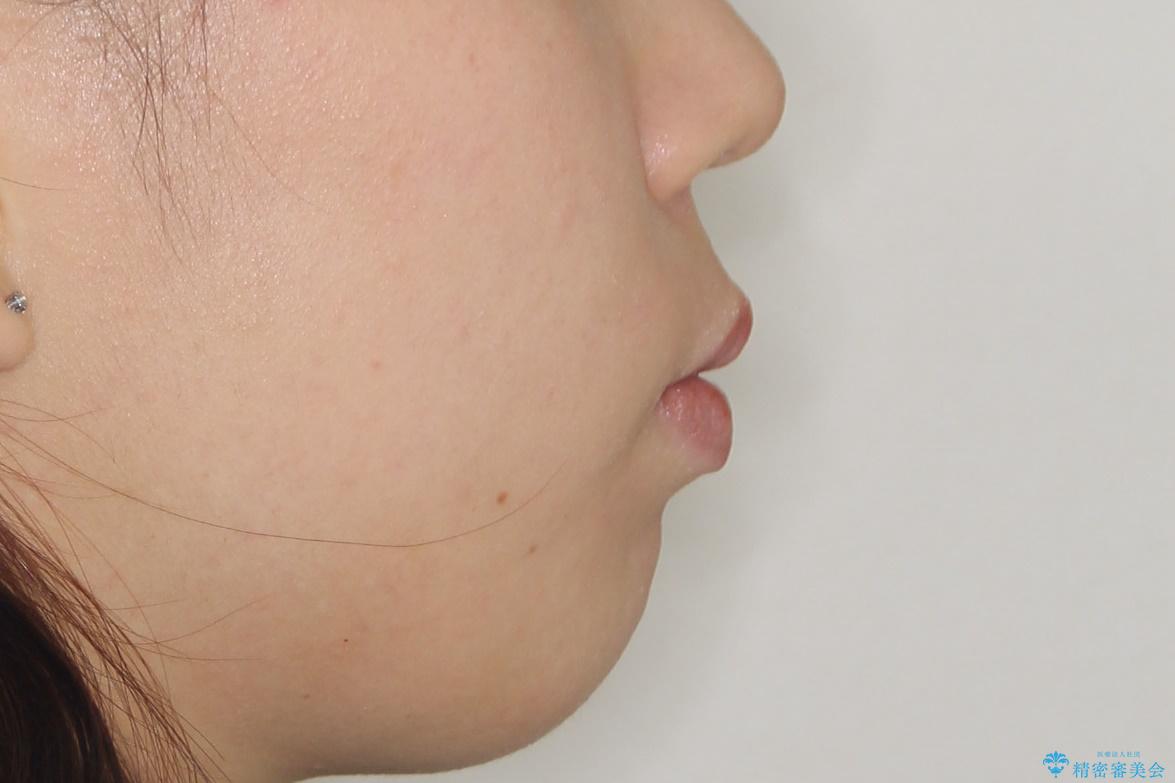 口元を下げてすっきりさせたい ワイヤー抜歯矯正で口元の改善の治療前(顔貌)