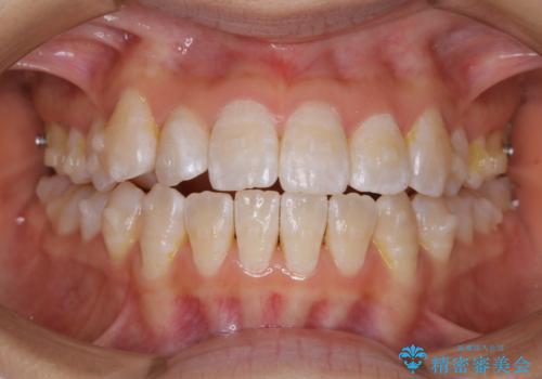 前歯のがたつきとオープンバイト:インビザラインでまとめて治すの治療中
