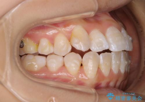 前歯のがたつきとオープンバイト:インビザラインでまとめて治すの治療中