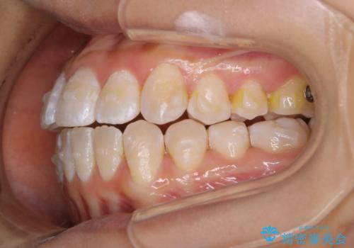 前歯のがたつきとオープンバイト:インビザラインでまとめて治すの治療中