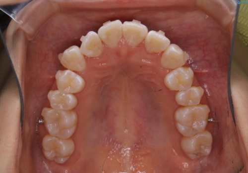前歯のがたつきとオープンバイト:インビザラインでまとめて治すの治療中