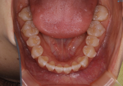 前歯のがたつきとオープンバイト:インビザラインでまとめて治すの治療中
