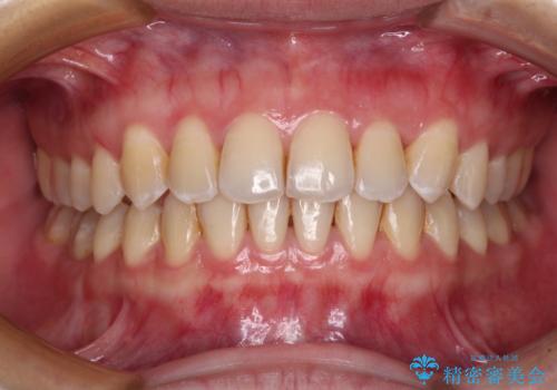 前歯の反対咬合　急速拡大装置とワイヤー装置であっという間の矯正治療の治療後