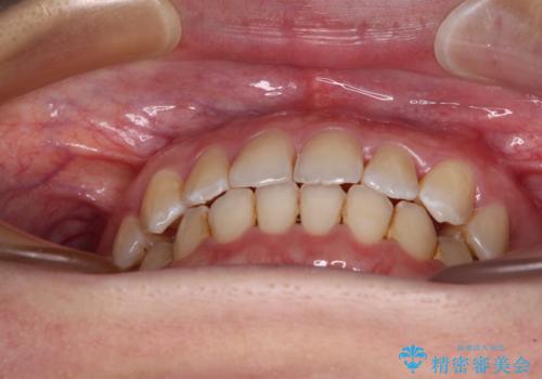 前歯の反対咬合　急速拡大装置とワイヤー装置であっという間の矯正治療の治療後