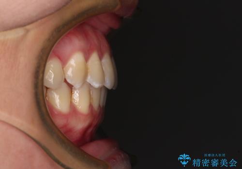 前歯の反対咬合 急速拡大装置とワイヤー装置であっという間の矯正治療の治療後