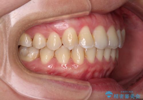前歯の反対咬合 急速拡大装置とワイヤー装置であっという間の矯正治療の治療後