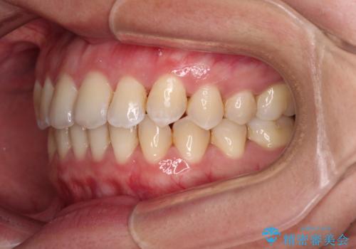 前歯の反対咬合 急速拡大装置とワイヤー装置であっという間の矯正治療の治療後