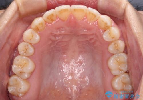 前歯の反対咬合 急速拡大装置とワイヤー装置であっという間の矯正治療の治療後