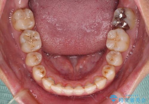 前歯の反対咬合 急速拡大装置とワイヤー装置であっという間の矯正治療の治療後